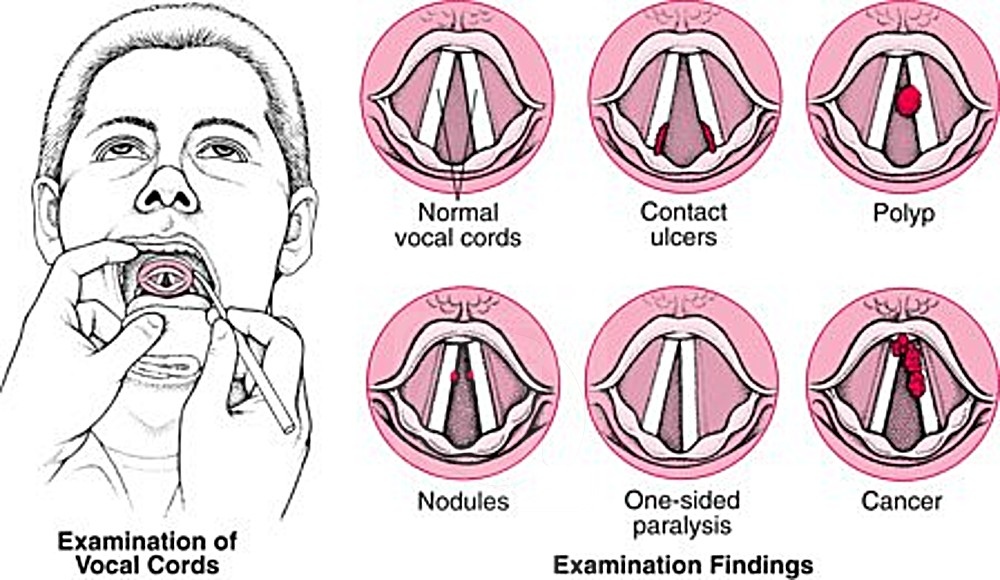 Голос голосовые связки. Ларингит голосовые складки. Как выглядят поврежденные голосовые связки. Патологии гортани голосовых связок.