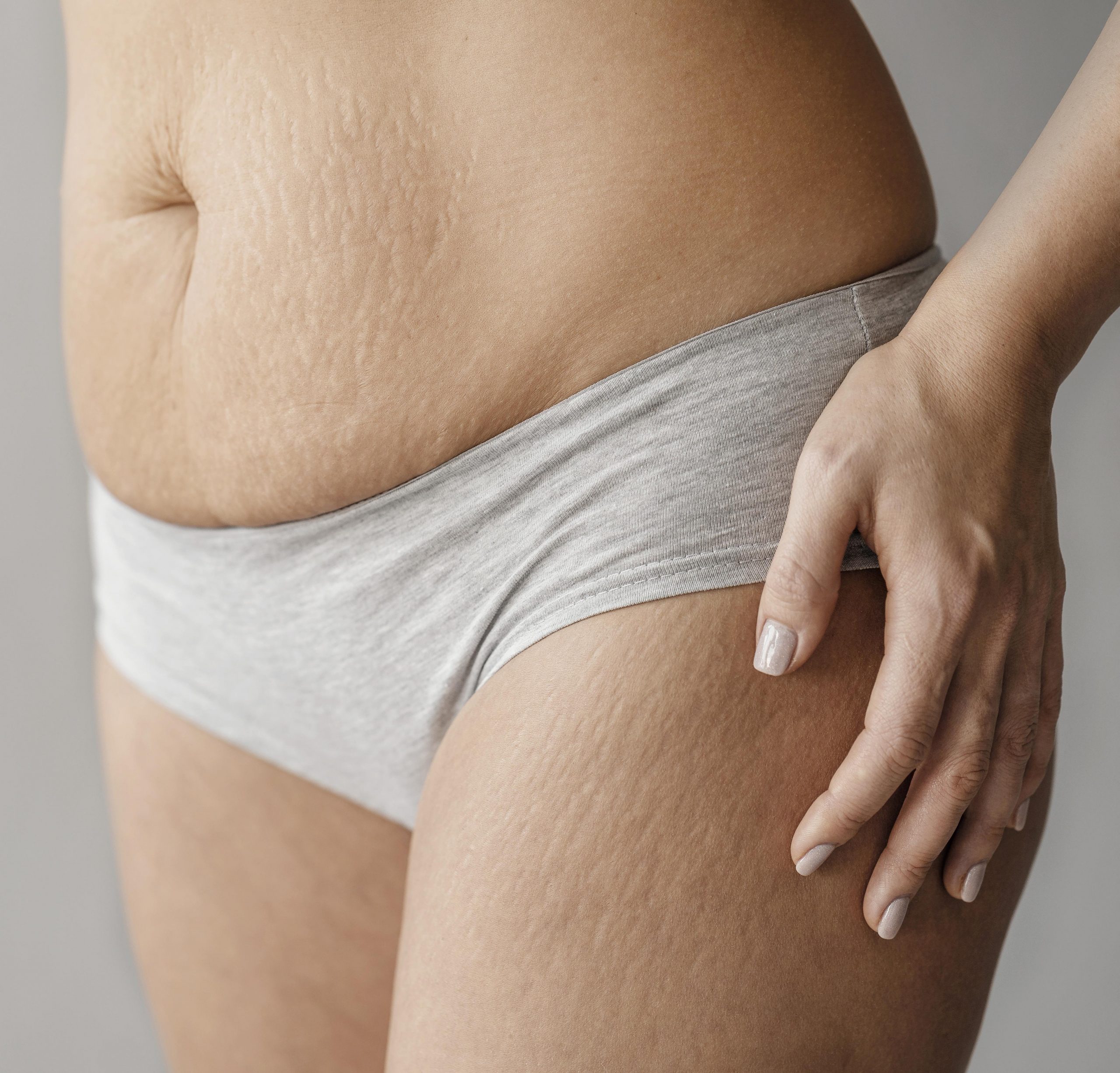 How to get rid of cellulite