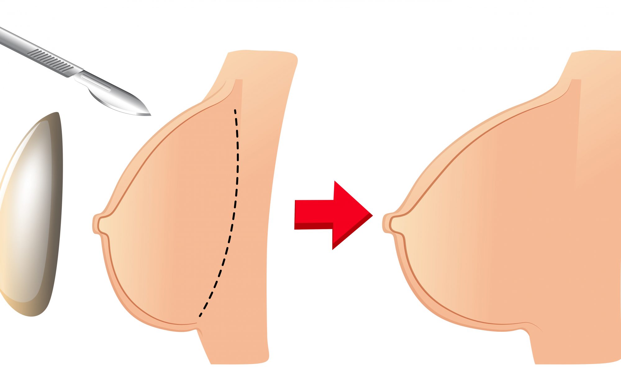 Ci sono alcune cose importanti da sapere prima di considerare un intervento di chirurgia estetica al seno.