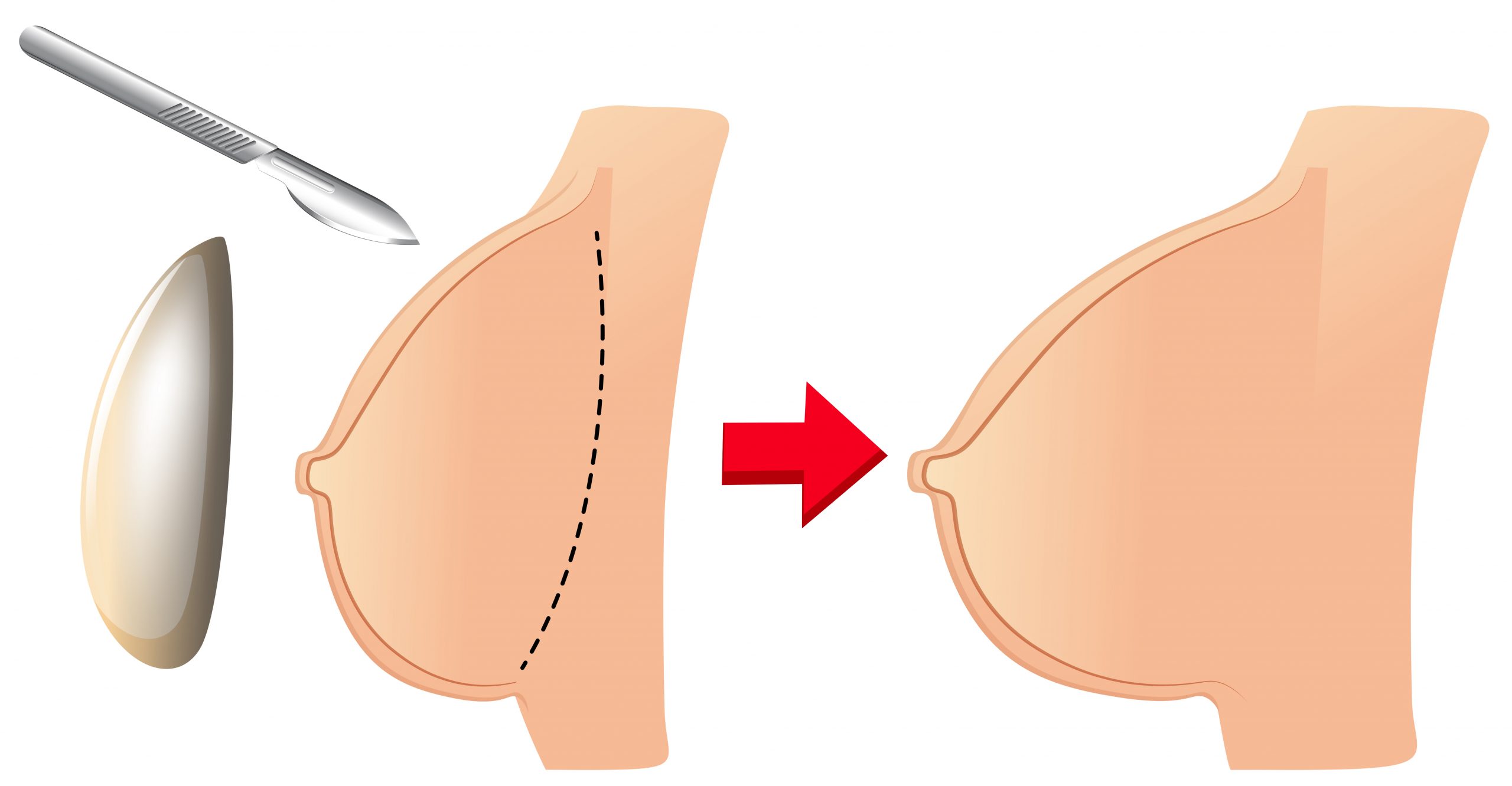 Ci sono alcune cose importanti da sapere prima di considerare un intervento di chirurgia estetica al seno.