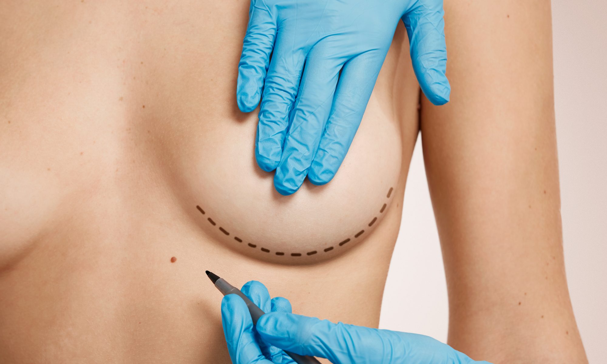 Breast Aesthetic Surgery What to know